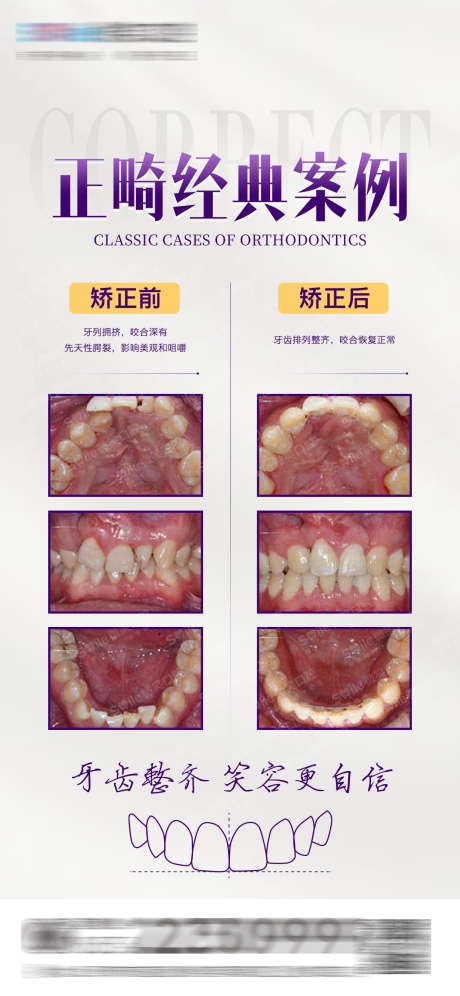 医美口腔正畸案例对比海报_源文件下载_PSD格式_1242X2688像素-种植牙,牙齿线稿,矫正,牙齿,海报,案例对比,正畸,口腔,医美-作品编号:2023032817445217-素材库-www.sucai1.cn