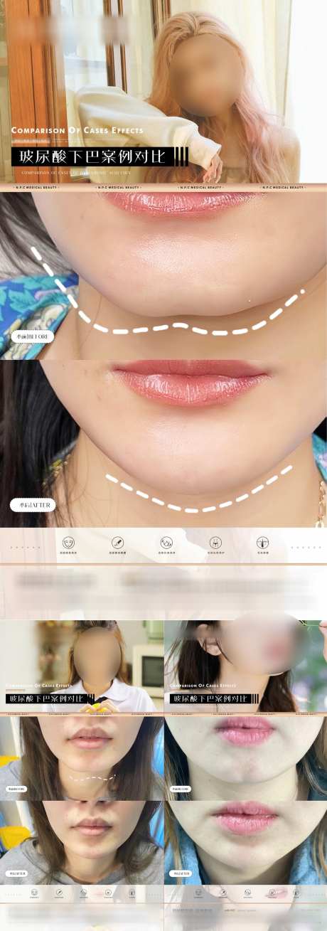 玻尿酸下巴_源文件下载_PSD格式_1100X3131像素-乔雅登,填充,对比,案例,下巴,玻尿酸,轮廓,微整,医美,海报-作品编号:2023122017018682-志设-zs9.com