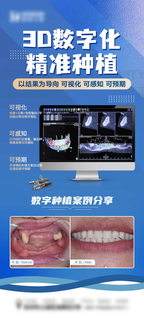 数字化种植_源文件下载_PSD格式_750X1654像素-技术,对比,案例,牙齿,种植牙,数字化,医疗,口腔,牙科,海报-作品编号:2024010415296511-志设-zs9.com