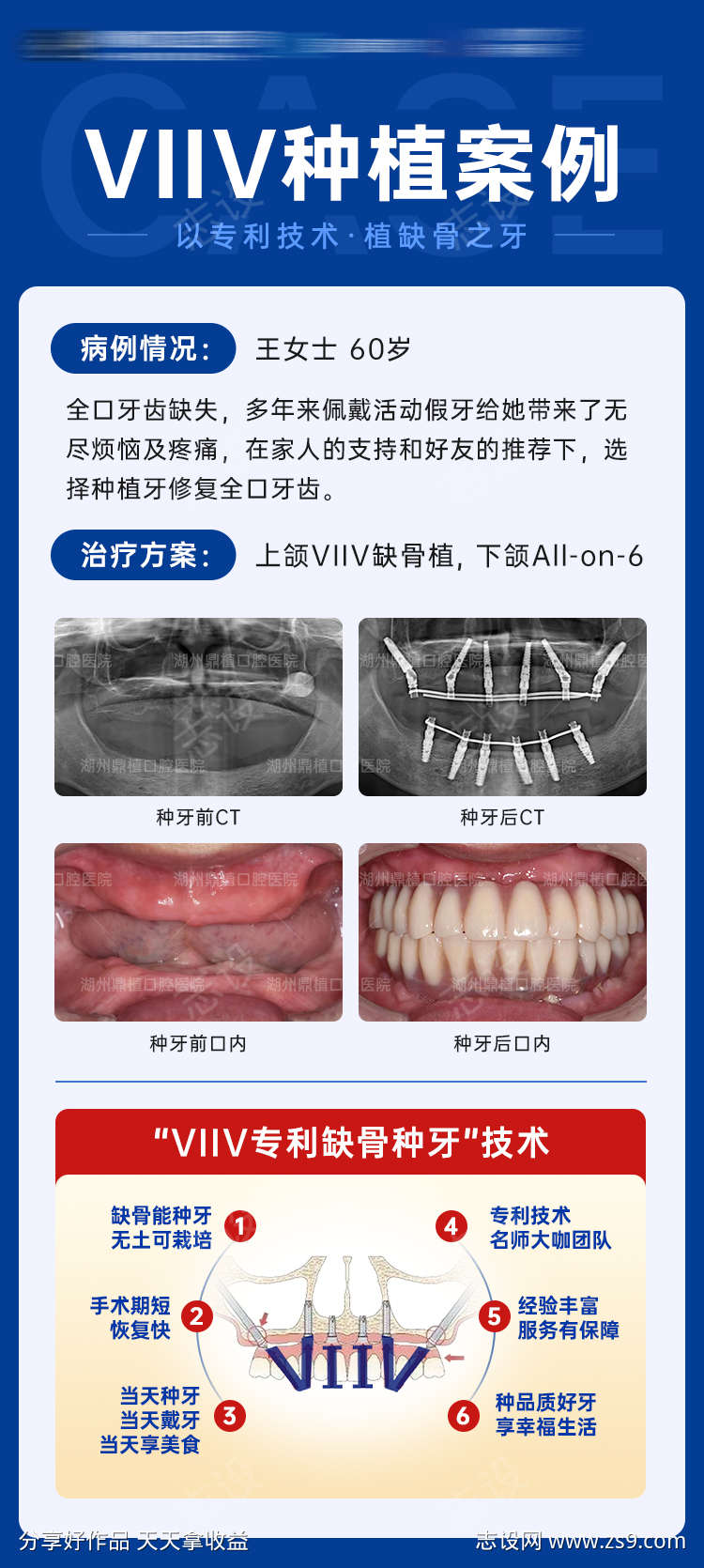 全口种植牙案例对比图海报