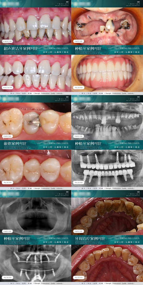口腔案例海报_源文件下载_PSD格式_2000X3981像素-系列,牙周,简约,案例,洁牙,洗牙,种植牙,口腔,医美,海报-作品编号:2024040409066676-志设-zs9.com